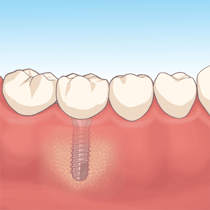 インプラント